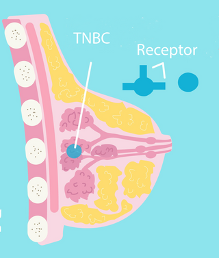 Medicinrådet og Tripple Negativ Brystkræft (TNBC)