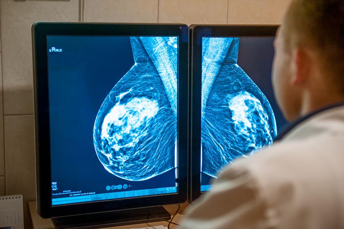 Løsningen er IKKE at afskaffe brystkræftscreening, der i stedet bør effektiviseres