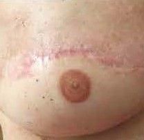 Kan man spare tatovering af brystvorter væk?