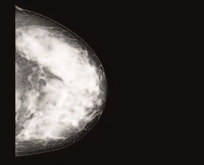 Screening for brystkræft bør individualiseres